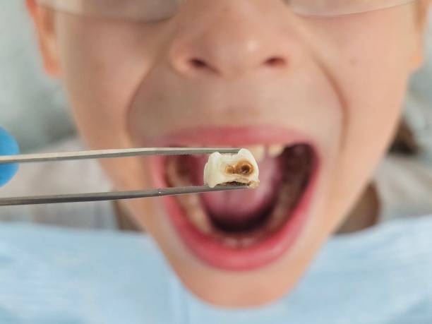 Best Root Canal Emergency Dentist  in Ferris, TX